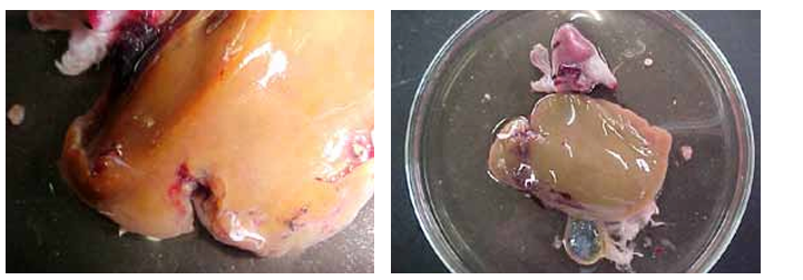 hepatoma disease